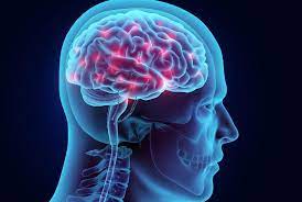 A representation image of Cerebral Hemorrhage, Image: Weill Cornell Medicine Newsroom