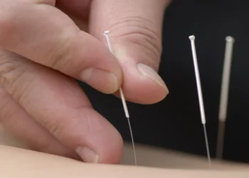 Acupuncture process (Representative Image)