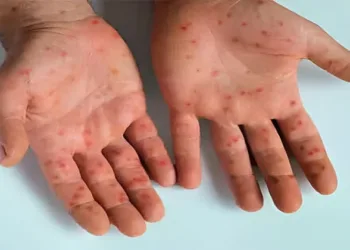 Representative image