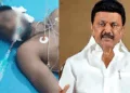 Severly injured migrant worker from West Bengal (Left) TN CM MK Stalin (Right)